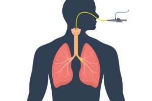 Bronchoscopy